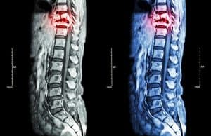 Why Spinal Cord Injuries Often Require a Lifetime of Medical Care