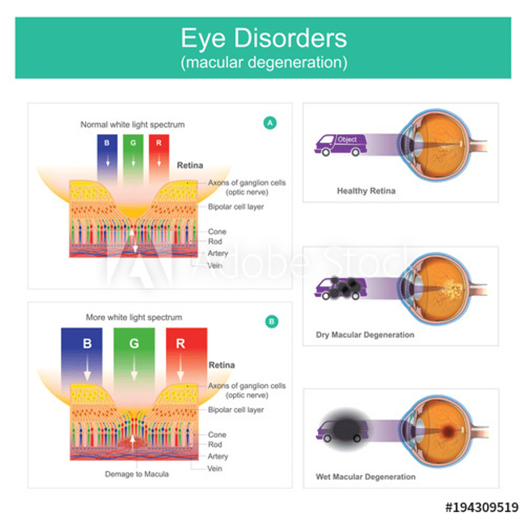 Elmiron Linked to Retina Damage and Vision Loss