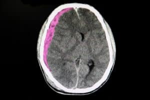 Subdural Hematoma