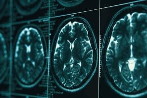 What’s the Difference Between a Concussion and a Traumatic Brain Injury?